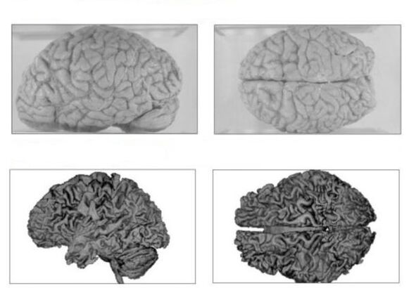 El cerebro de una persona sana (arriba) y el cerebro de un alcohólico con consecuencias irreversibles (abajo)