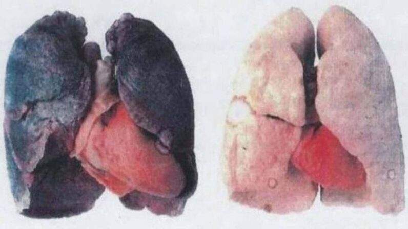 Muchos alcohólicos crónicos mueren debido a daño pulmonar (izquierda)