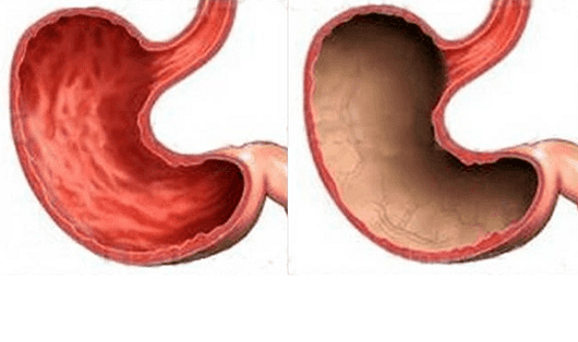 Úlcera, gastritis, cáncer y otras patologías del estómago (a la derecha), cuya aparición fue causada por el alcohol. 